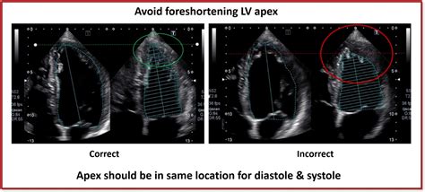 lv foreshortening|THE AMERICAN SOCIETY OF ECHOCARDIOGRAPHY .